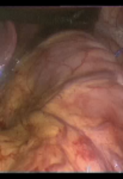 Laparoscopic Gastric Plication-Surgical Technique